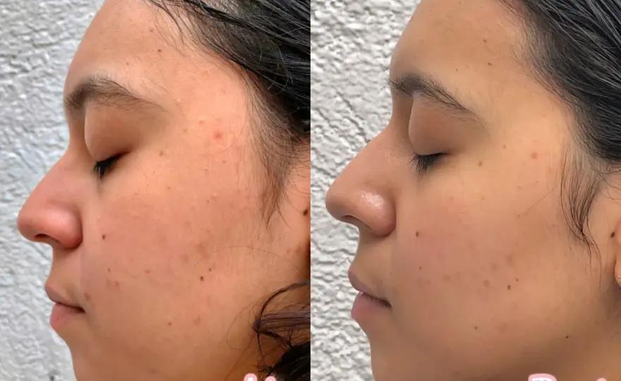 Vitaminas faciales antes y después - qué cambia de verdad