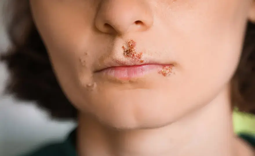 Gengivostomatite erpetica, come riconoscerla e quando agire