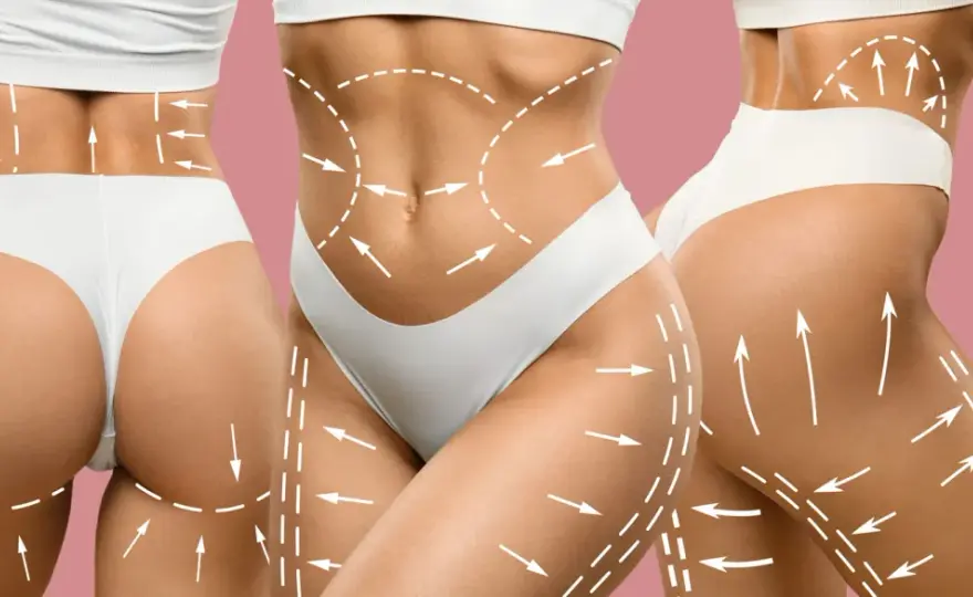 Liposukcja: Co to jest, dla kogo, jak przebiega i ile kosztuje?