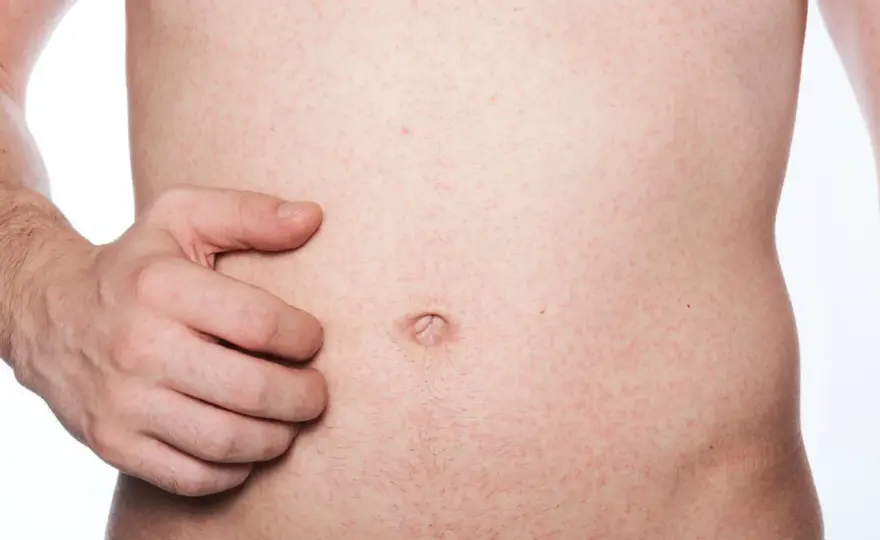 Ausschlag am Bauch - Ursachen erkennen und richtig handeln