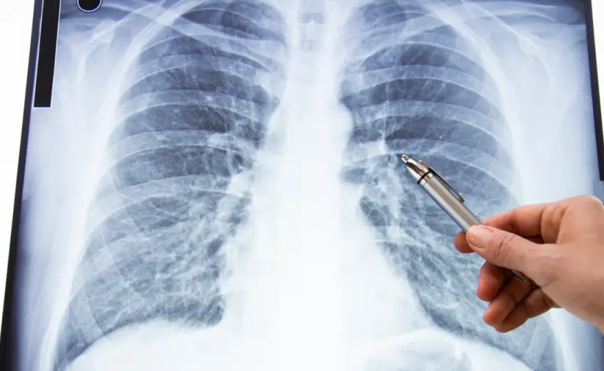 Grzybica płuc - Objawy, leczenie, diagnostyka. Kiedy działać?