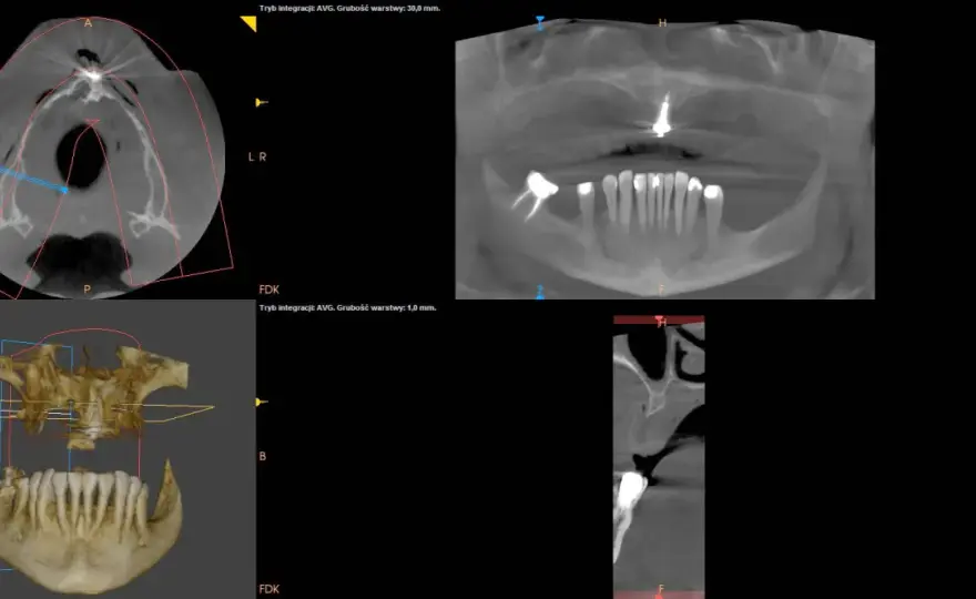 CBCT zębów - Kiedy tomografia stożkowa ma sens?