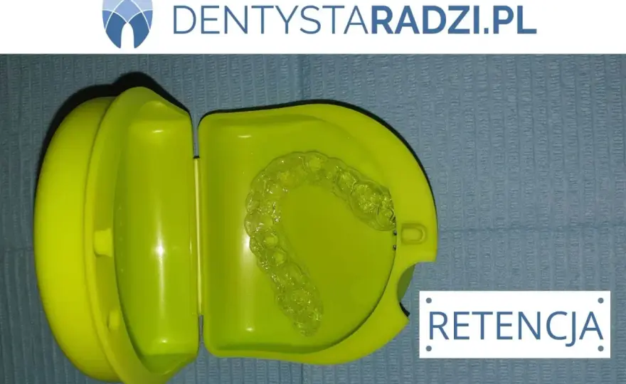 Cena nakładki retencyjnej po aparacie: Ile kosztuje i którą wybrać?