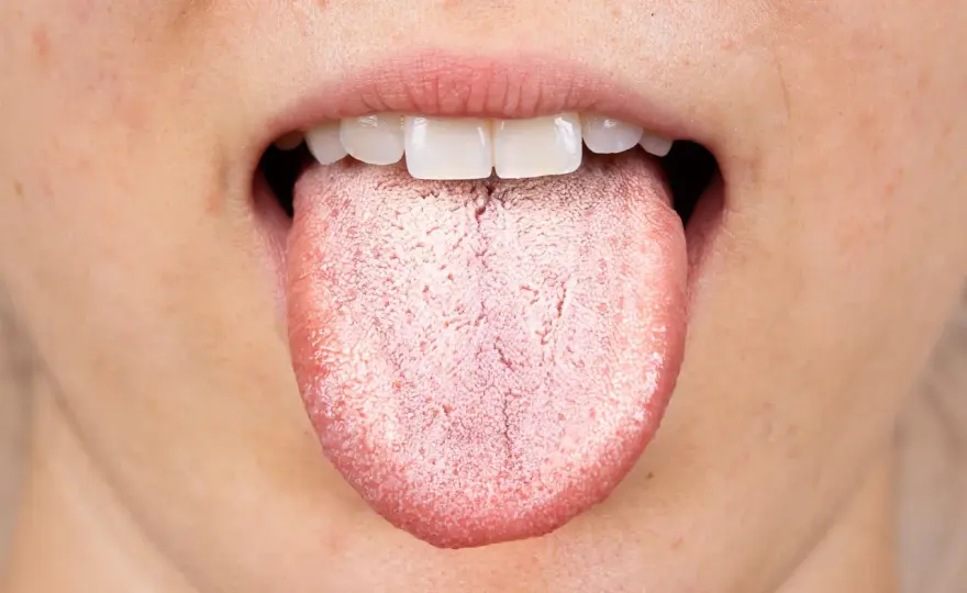 Lingua bianca dopo antibiotici - come riconoscere patina e candidosi