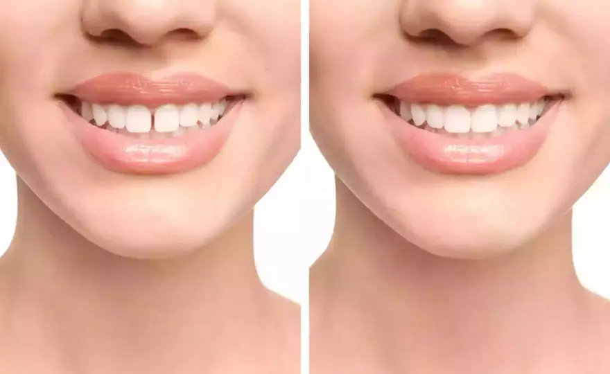 Diastema - czy jest dziedziczna? Kiedy wymaga leczenia?