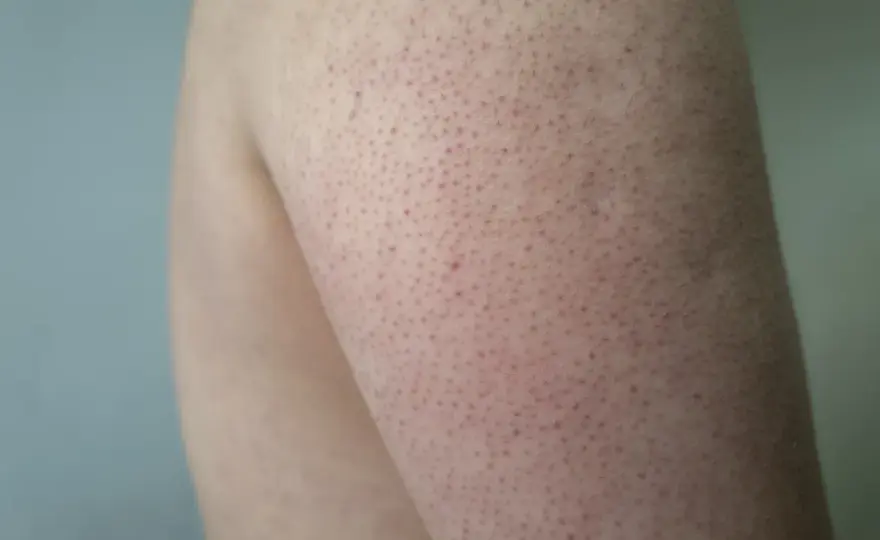 Keratosis pilaris barn - Känna igen, behandla & när söka vård