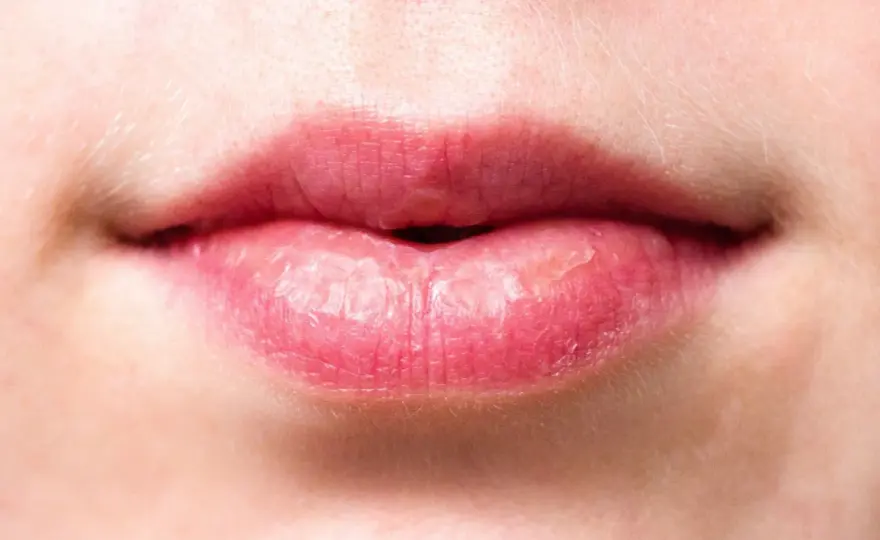 Labios quemados por el sol - cómo aliviar y protegerlos