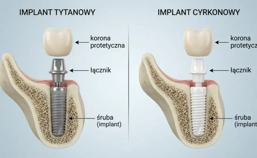 Rodzaje implantów zębowych - tytan, cyrkon i wybór w praktyce