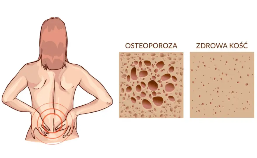 Osteoporoza a rak kości - Jak je odróżnić?
