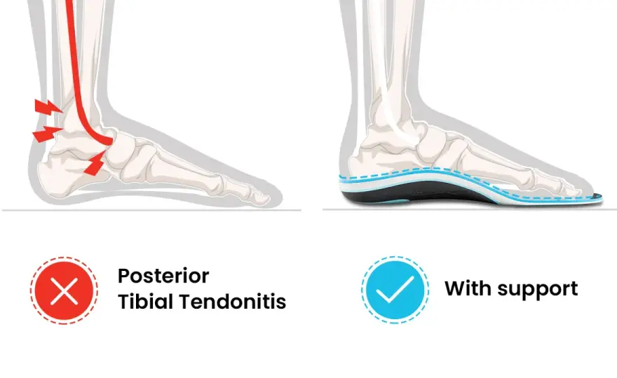 Tibialis-posterior-Sehne: Welche Orthese wirklich hilft