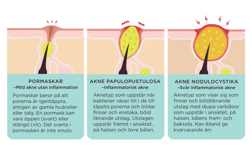 Hormonella utslag - Känn igen, förstå & behandla effektivt