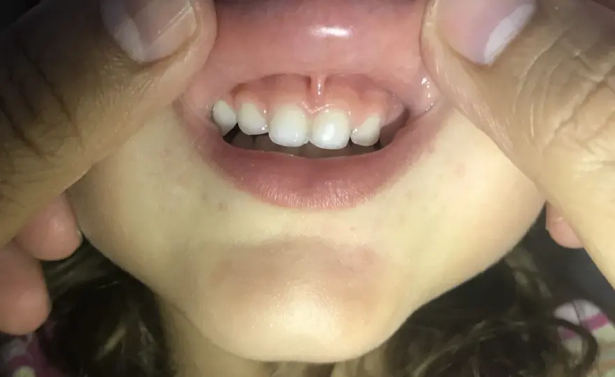 Frenillo labial inferior - cuándo preocupa y cuándo operar