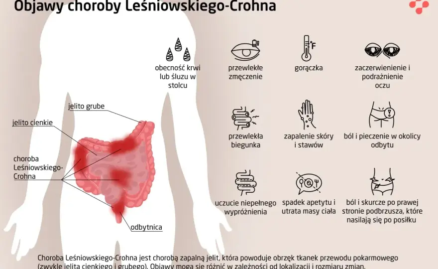 Objawy choroby Leśniowskiego-Crohna - jak je rozpoznać?