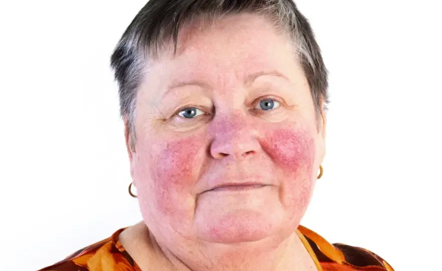 Rosacea på halsen? Så skiljer du det från eksem & akne
