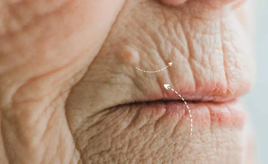 Arrugas del labio superior - cómo suavizarlas sin perder naturalidad
