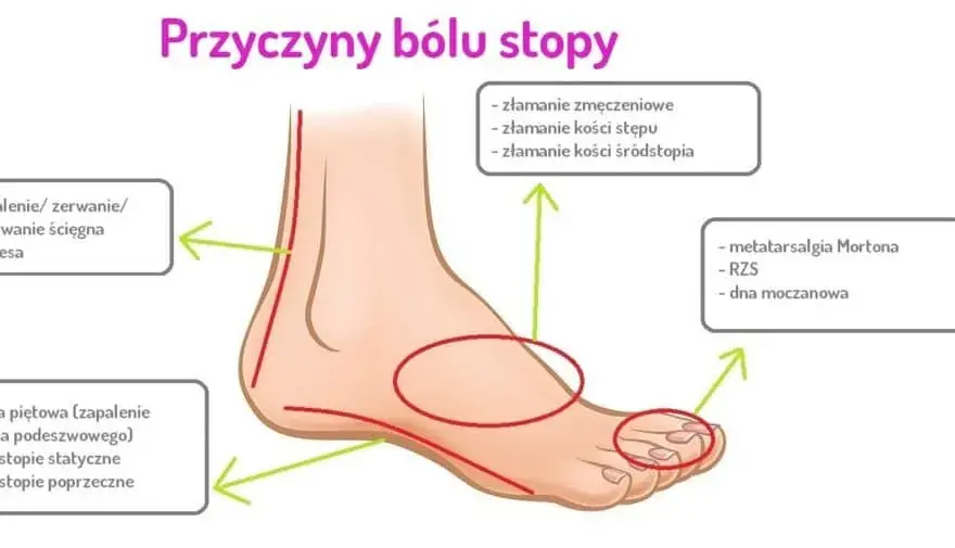 Ból śródstopia przyczyna: poznaj najczęstsze źródła dyskomfortu