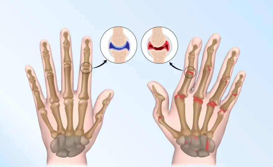 Rheumatoide Arthritis erkennen - worauf Sie achten sollten