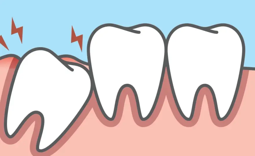 Dente incluso dolorante - Soluzioni e quando estrarre