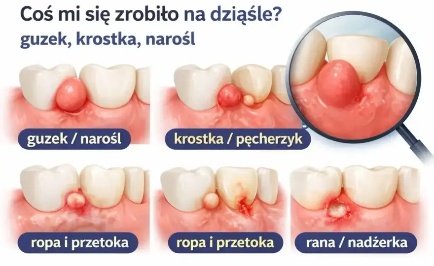 Guzek na dziąśle - Torbiel, ropień czy co innego? Sprawdź!