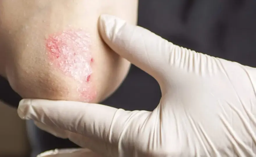 Psoriasi al gomito nei bambini - come riconoscerla