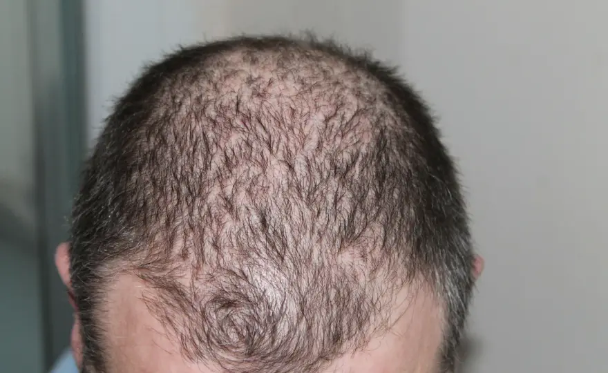 Alopecia areata - vilka behandlingar hjälper egentligen?