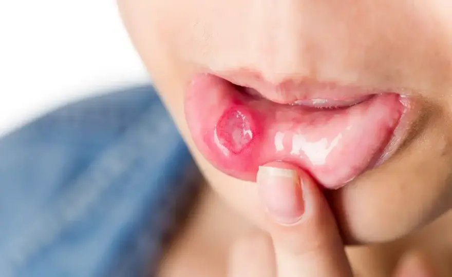 Afta gengivale, cause, rimedi e quando andare dal dentista