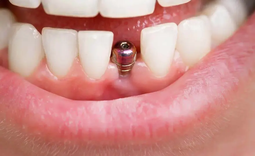 Implant zęba - Kiedy daje najlepszy efekt? Przewodnik