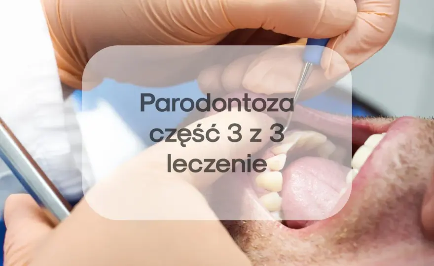 Laserowe leczenie paradontozy - ile kosztuje i kiedy ma sens