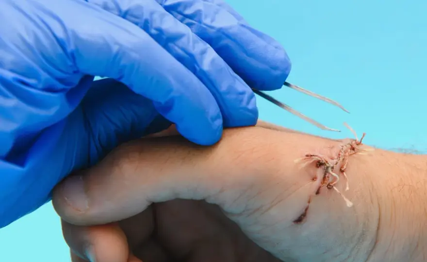 Quand faire enlever un point de suture ? Délais et soins