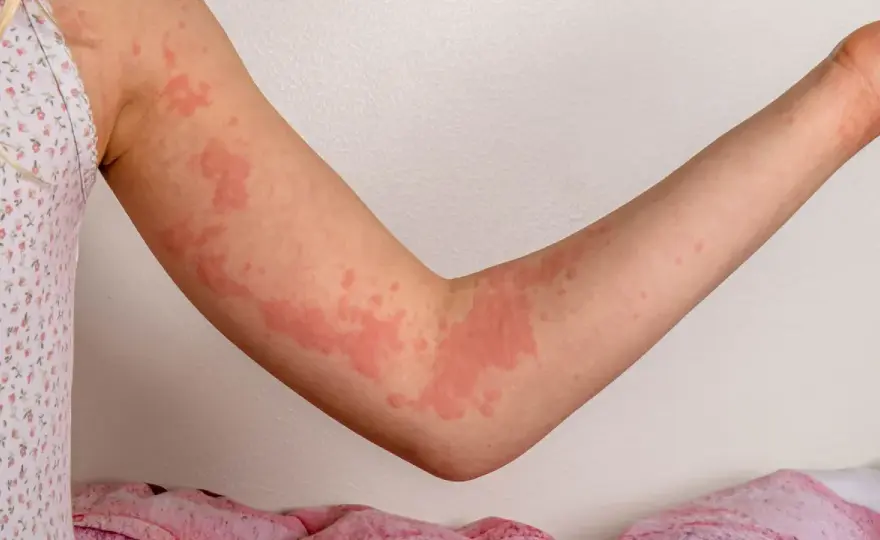 Orticaria bambini - Riconosci i sintomi e cosa fare subito