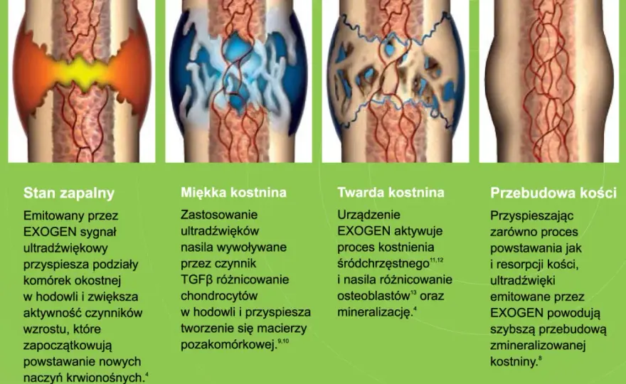 Co przyspiesza zrost kości po złamaniu? Skuteczne metody