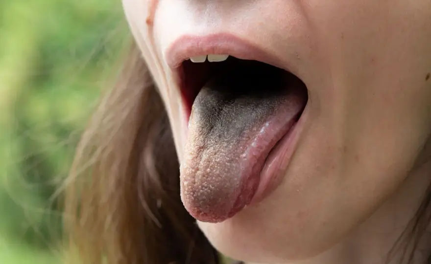 Puntino nero sulla lingua - Quando preoccuparsi e cosa fare?