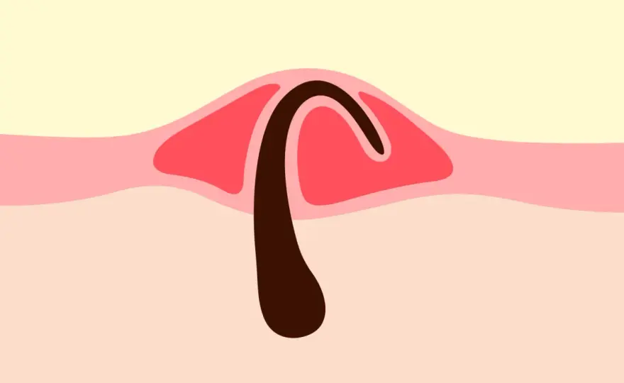 Bouton autour d’un poil pubien - que faire ?