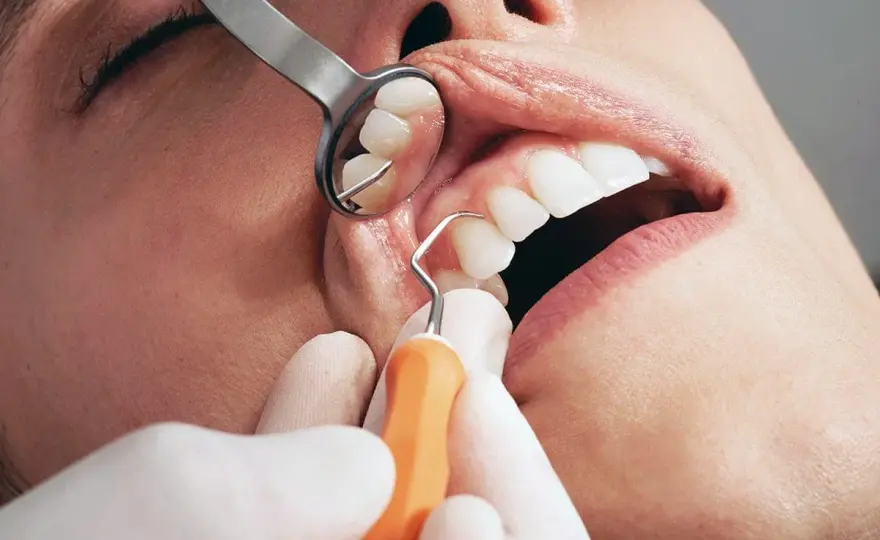 Curettage gengivale: serve davvero? La guida completa