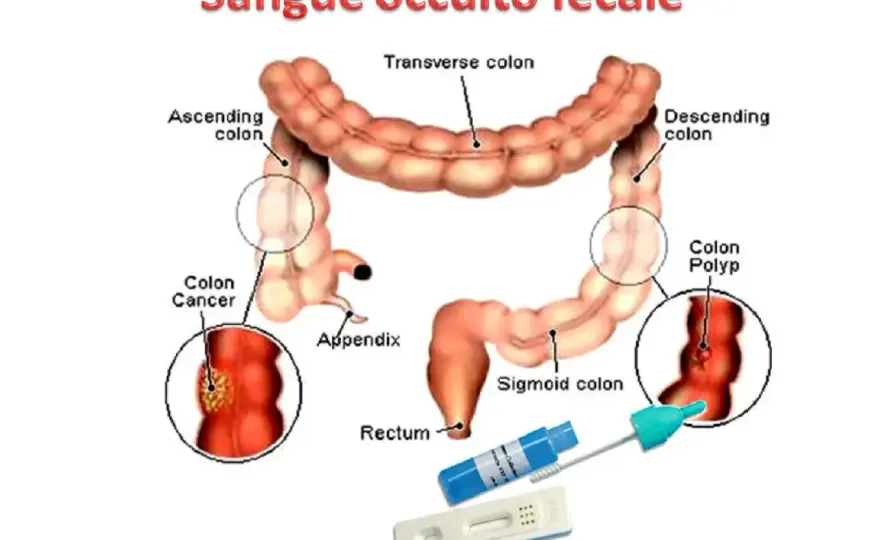 Sangue occulto nelle feci - cosa significa e cosa fare