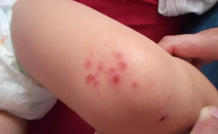 Impetigine nei bambini: come riconoscerla e cosa fare