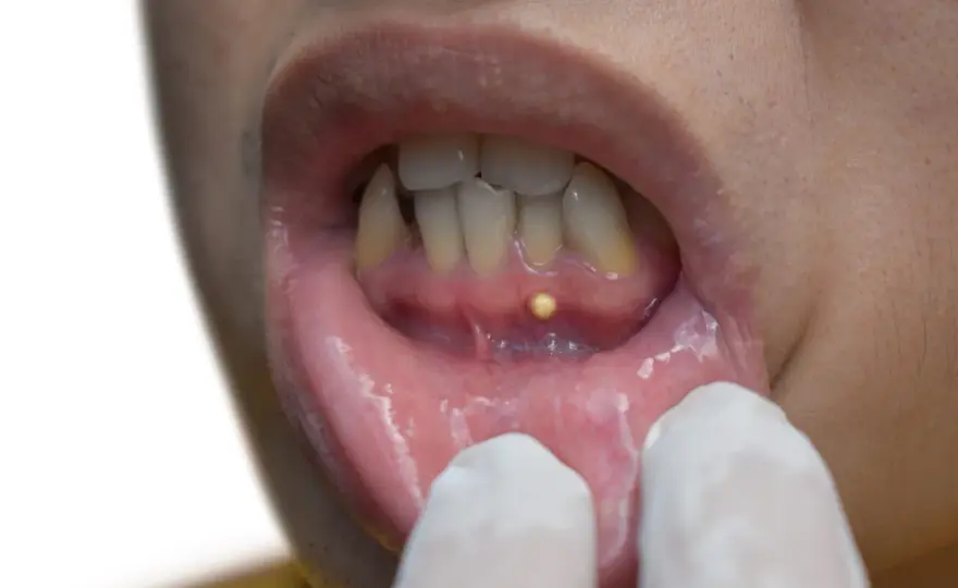 ¿Quiste gingival o absceso? Diferencias y cuándo ir al dentista
