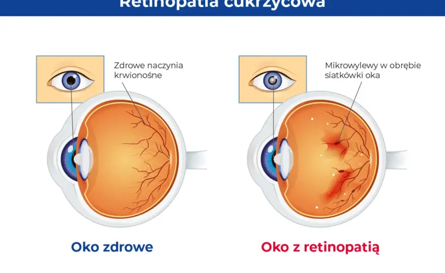 Retinopatia i zmiany siatkówki - objawy, badania, leczenie