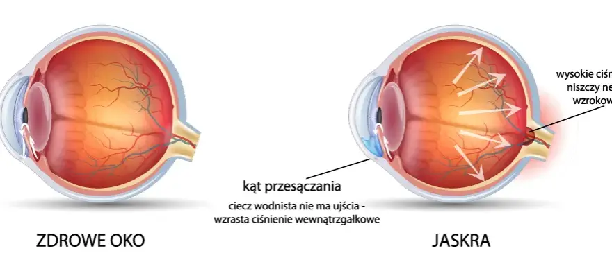 Jak sprawdzić czy mam jaskrę? Objawy i ważne badania, które ratują wzrok