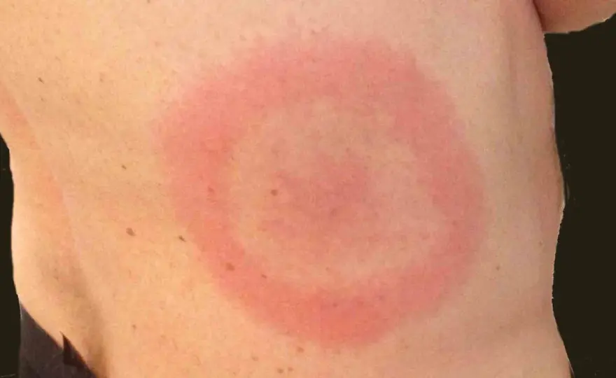 Allergiska utslag - Känn igen symtom och få snabb lindring