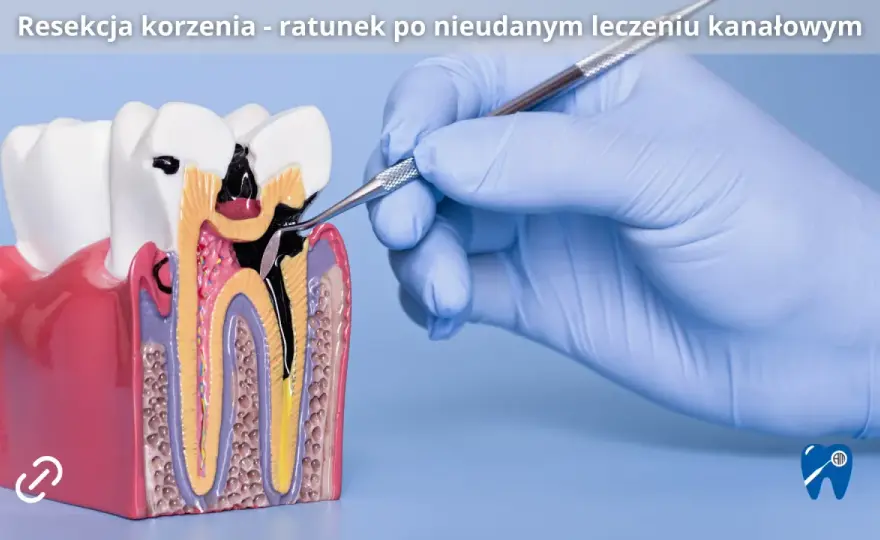Resekcja zęba - czy warto ratować ząb po kanałowym?