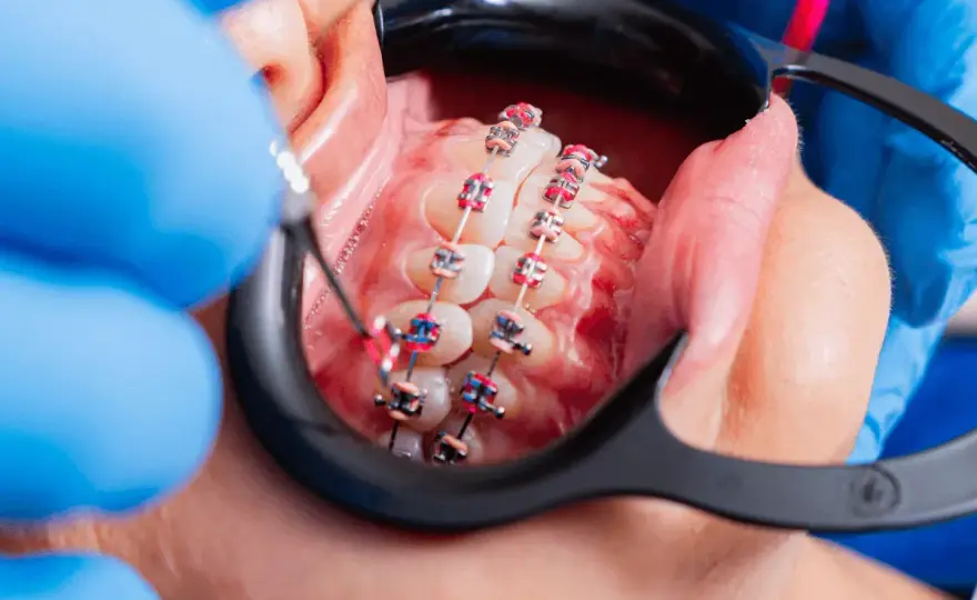Implant i aparat ortodontyczny - Jaka kolejność leczenia?