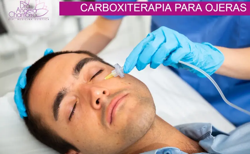 Carboxiterapia para ojeras - ¿Funciona para ti?