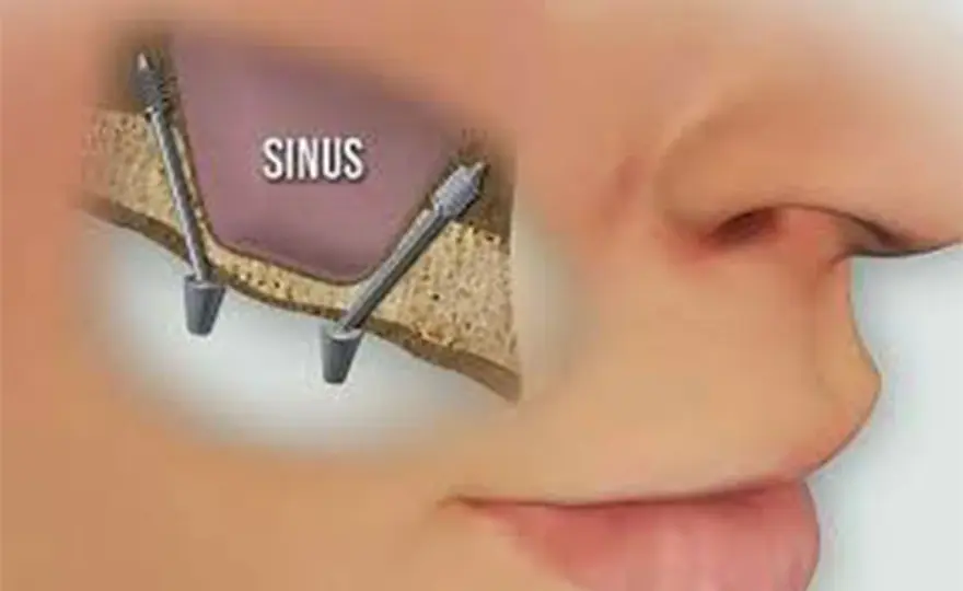 Sinus lift, tecniche, tempi, rischi e costi