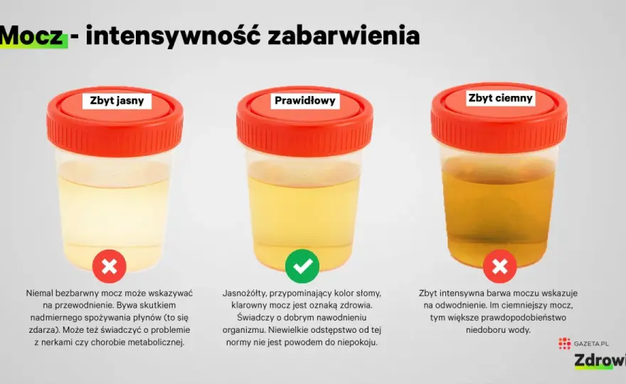 Śluz w moczu - czy to zawsze powód do niepokoju?