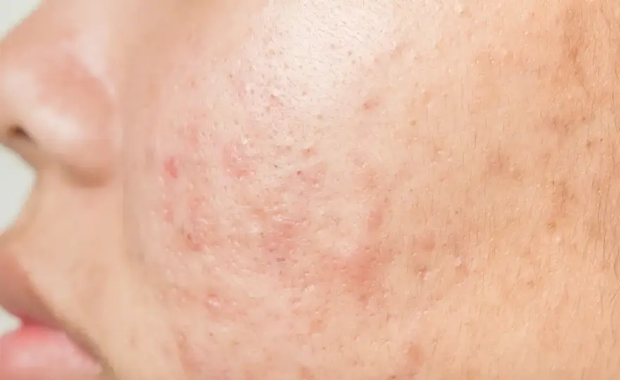 Acné du visage - comprendre les causes des boutons