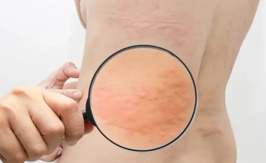 Alergia na nasienie - jak odróżnić ją od infekcji i podrażnienia