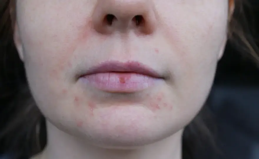 Dermatoza okołoustna - objawy, pielęgnacja i leczenie