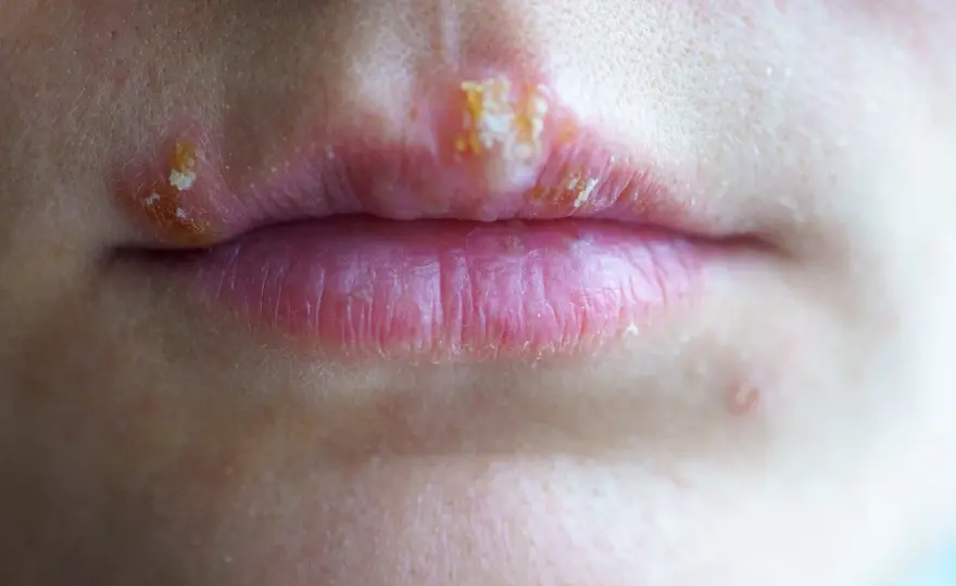 ¿Se contagia el herpes labial antes de la ampolla?