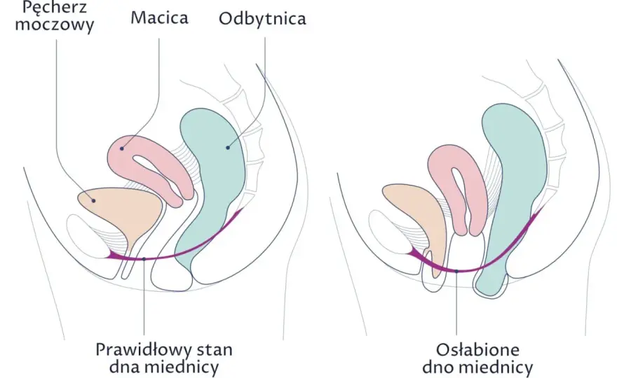 Obniżenie narządu rodnego - objawy, leczenie, zapobieganie